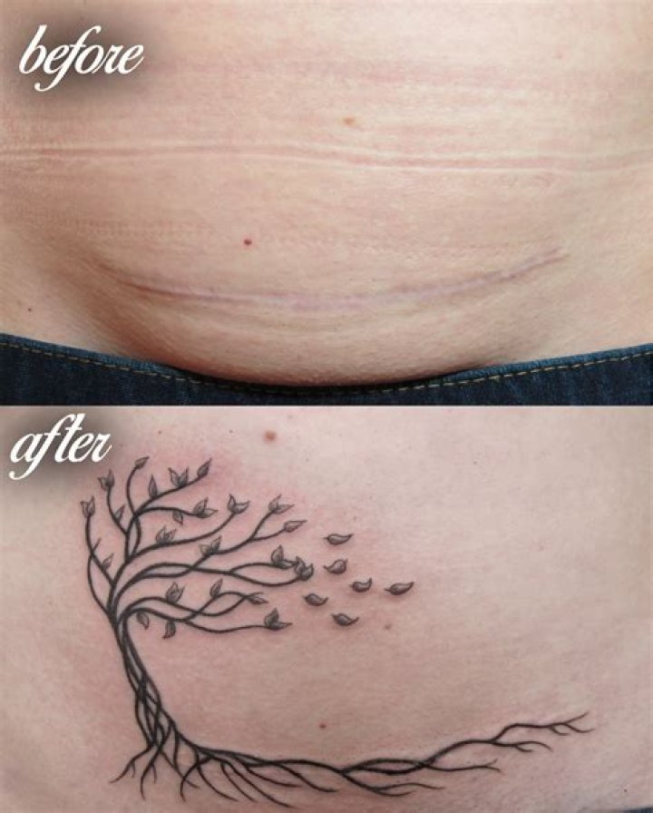 Can you tattoo over C-section scars?